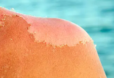 피부암 초기증상 5