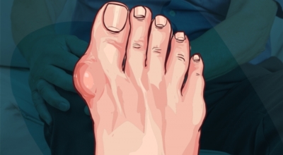 통풍이미지