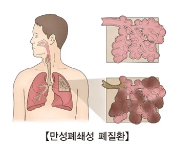 폐질환의 종류 7가지와 예방법 건강관리 필수_1