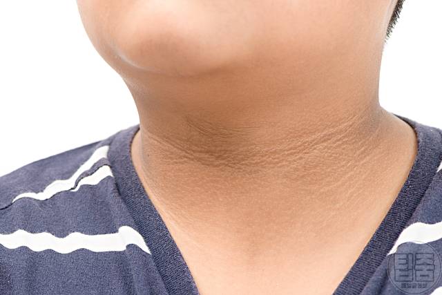 당뇨 증상 목 겨드랑이 착색 당뇨 걸리는 식습관