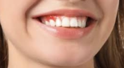 잇몸이 붓고 아플때