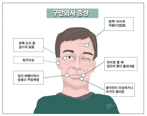 구안와사 증상