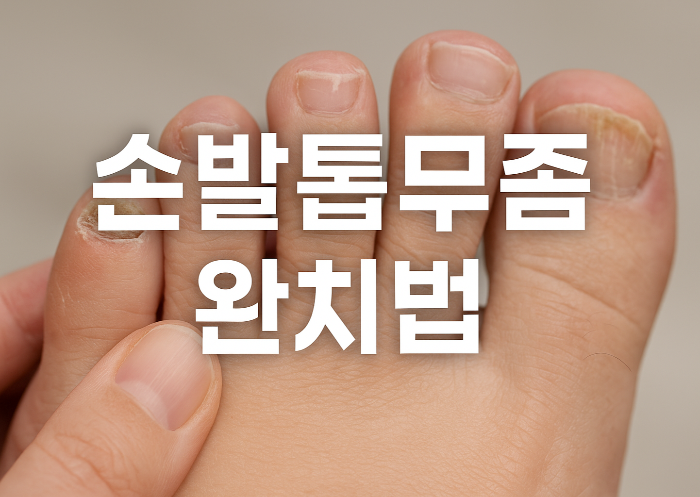 손발톱무좀 완치법 썸네일 이미지