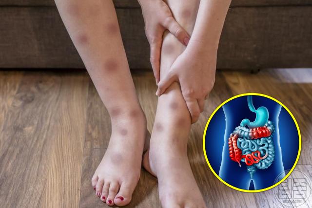 크론병 증상 종아리 붉은 반점 결절