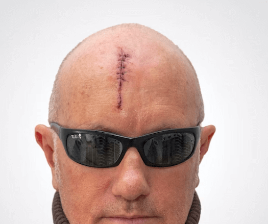 봉와직염 증상 - 감염