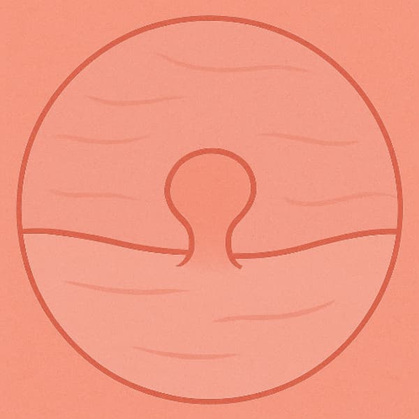 항문 피 - 직장 폴립, 대장 폴립, 혹, 돌기