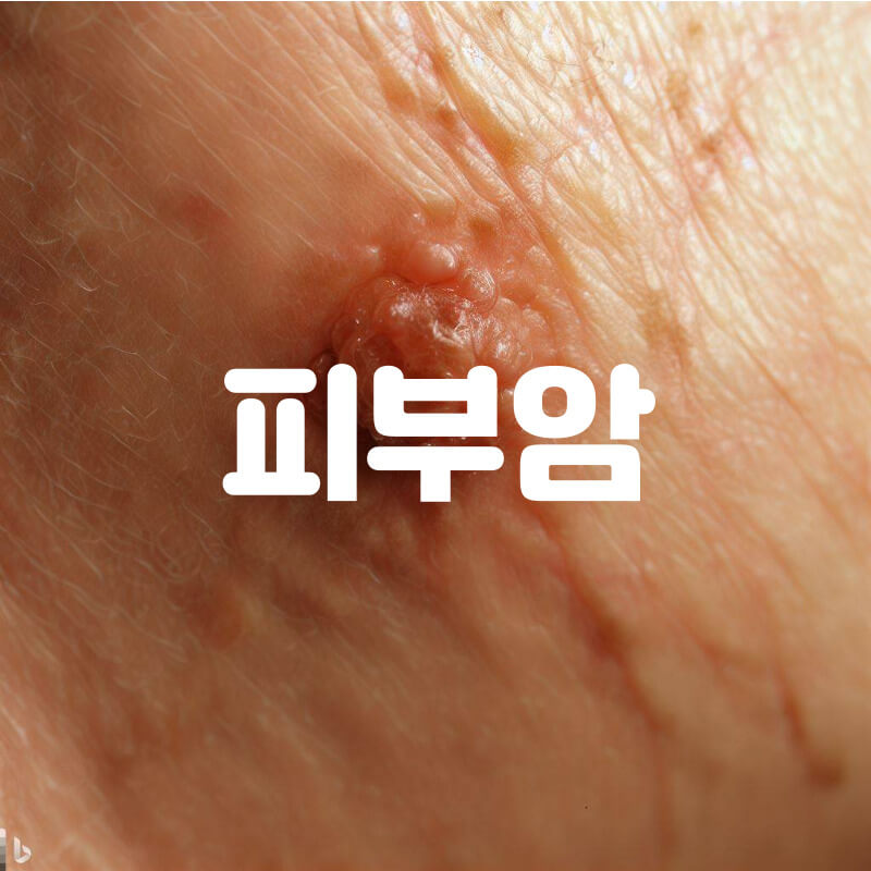 피부암