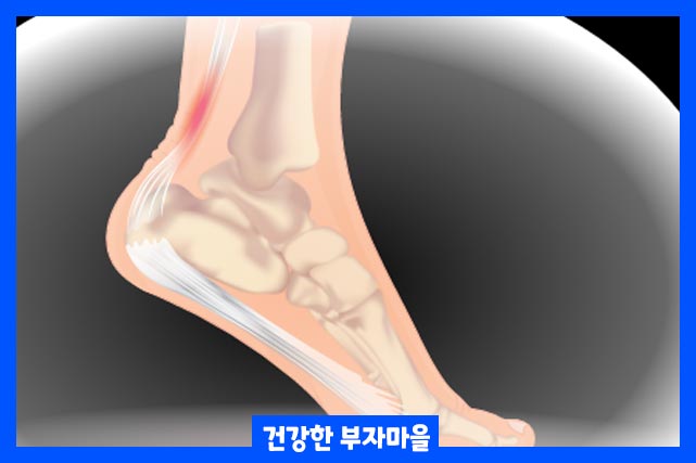 아킬레스건 힘줄은 달리거나 운동할 때 또는 넘어진 후 과도한 스트레칭으로 인해 찢어지거나 파열