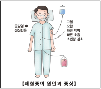 감기인 줄 알고 방치했다가 사망하는 '패혈증(Sepsis)' 