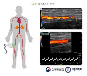 버거병(폐색혈전혈관염)