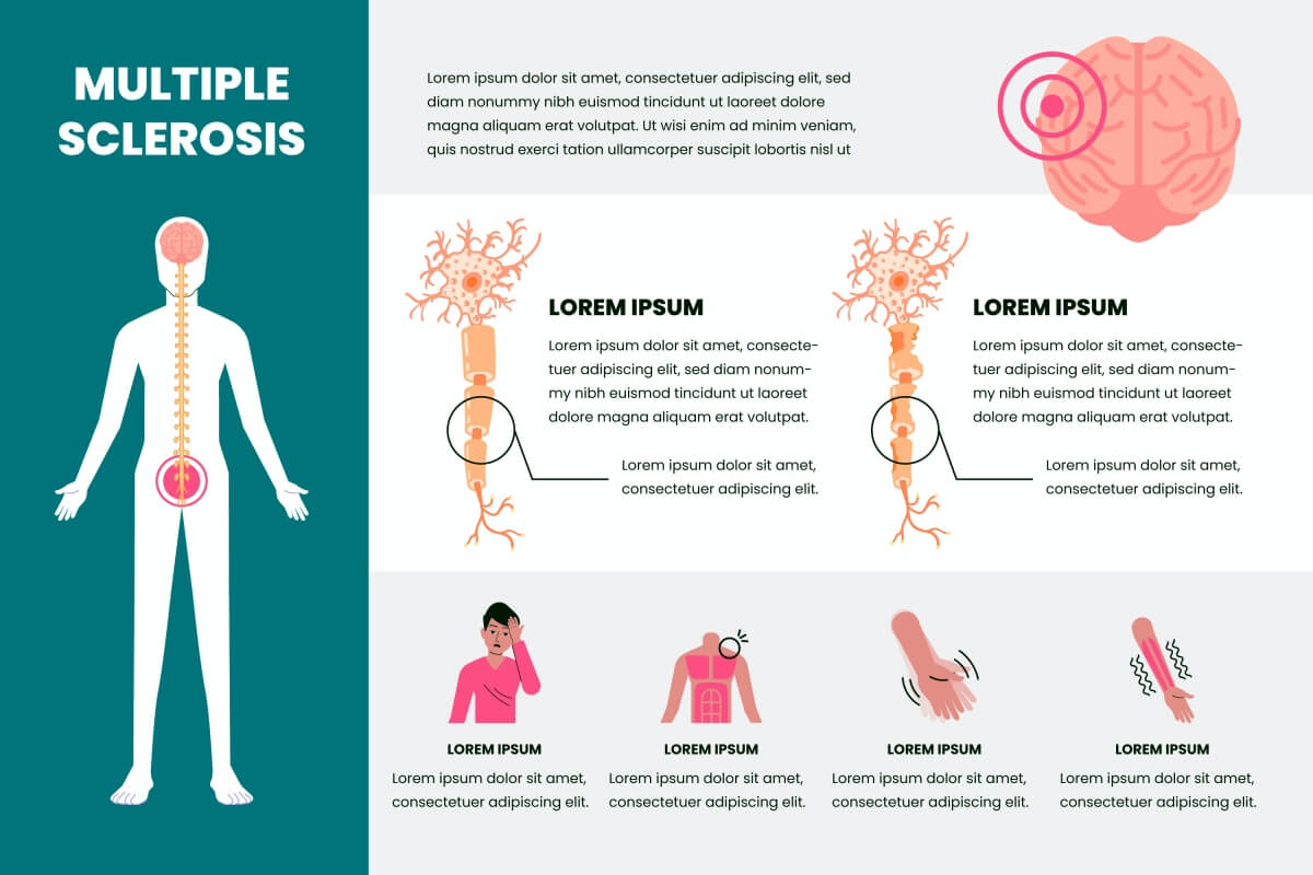 다발성경화증-마이엘린