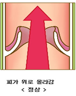 하지정맥류-다리가-붓는-이유