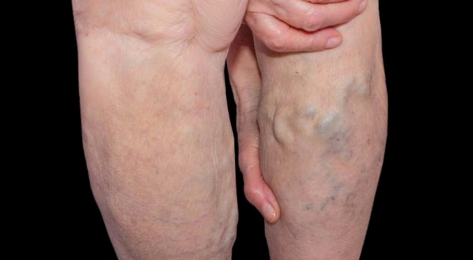 하지정맥류 베나실 치료법 및 장단점