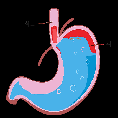 속쓰림