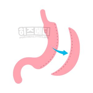 철결핍성 빈혈 원인 증상