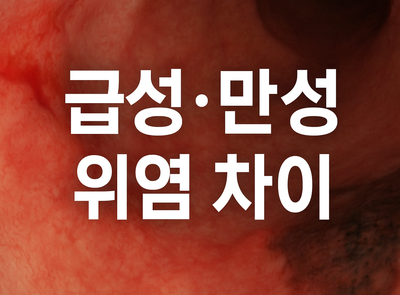 급성 위염과 만성 위염의 차이 한눈에 정리