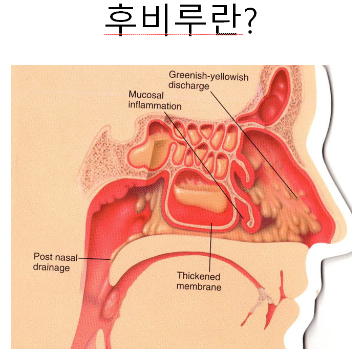 역류성 식도염 증상부터 관리까지