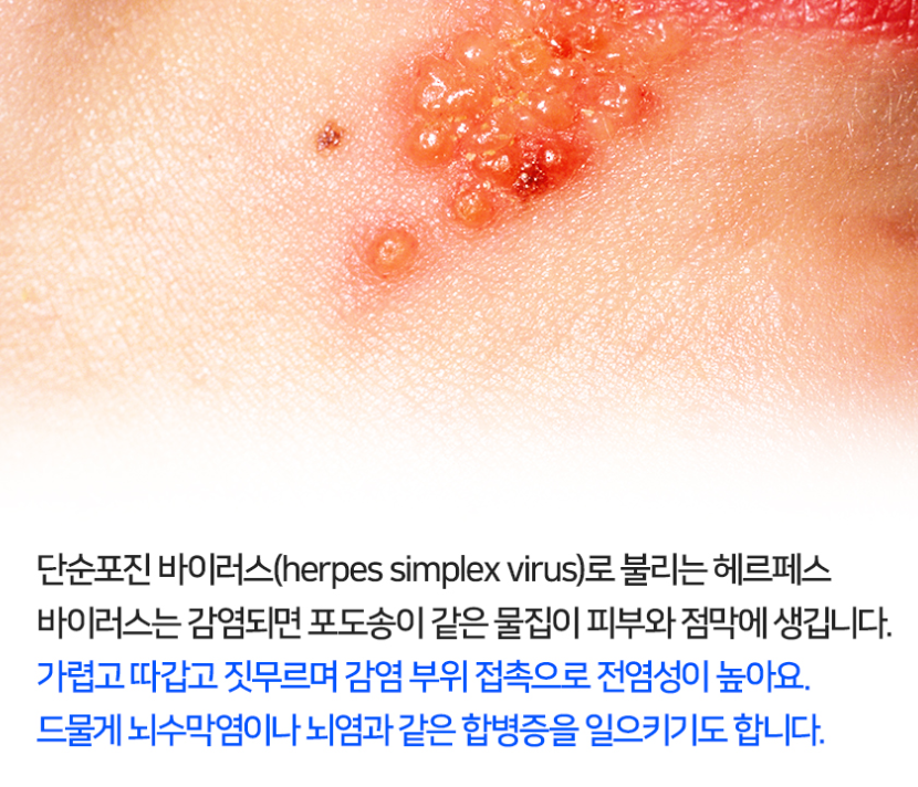 입술수포