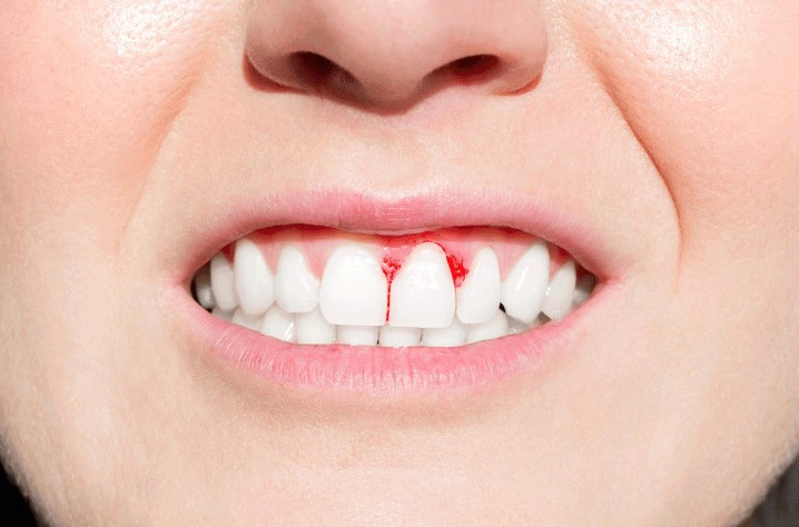 치주병 원인 증상 진행과정 치료 예방법 정리