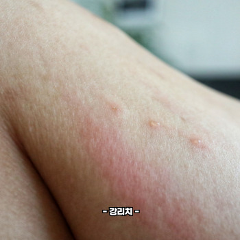 대상포진 백신 