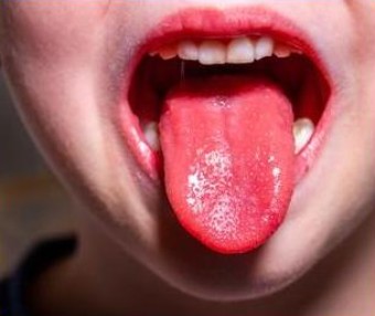 성홍열로 인한 딸기혀 증상