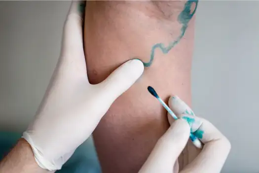 하지정맥류 초기 증상과 원인 치료방법