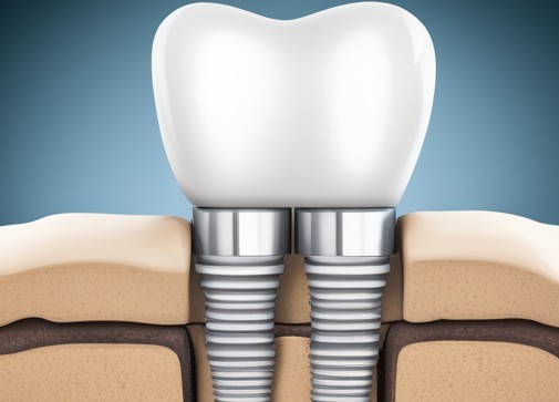 안산시-상록구-임플란트-치과-가격-비용-싼-곳,저렴한-곳,잘하는-곳,유명한-곳-BEST20-추천17