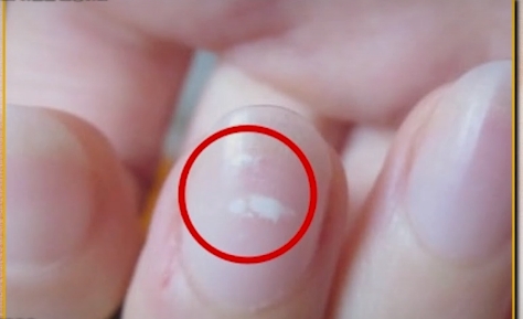 아연-결핍시-나타나는-손톱의-흰-반점