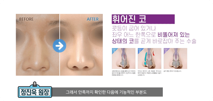 흰코 성형수술 - 정진욱 원장