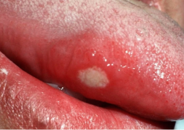 설암(혀암) 초기증상과 원인