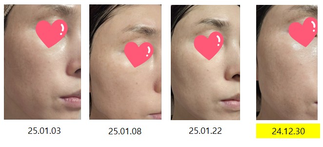 2025년 1월 과채 주스 먹은 후 왼쪽 얼굴 피부 변화 사진