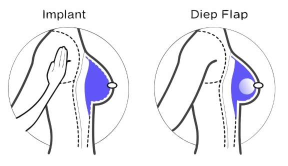 유방재건술 수술과정