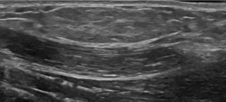 지방종 초음파 영상