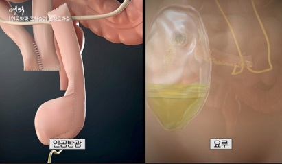 인공방광