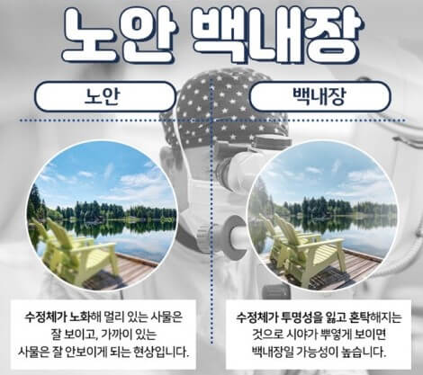 노안 백내장