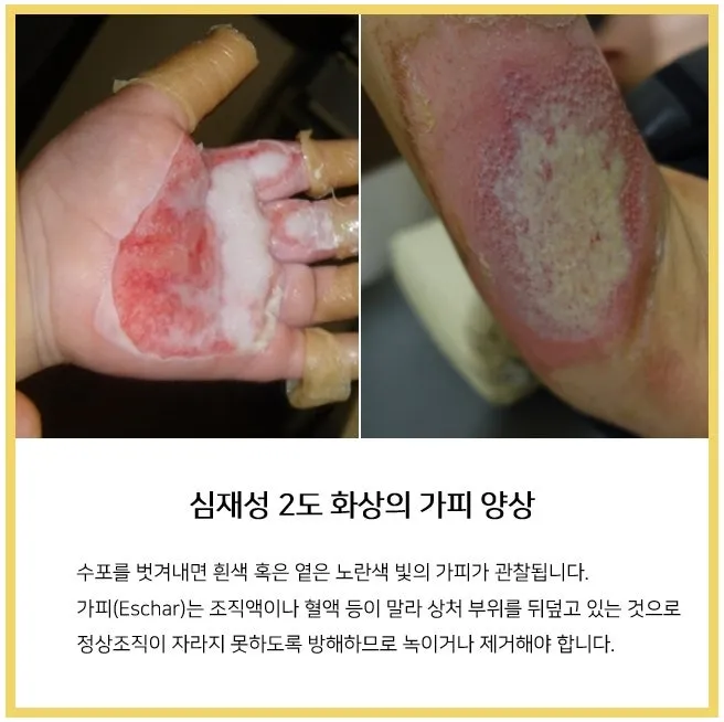 2도 화상 증상 자가치료 회복기간 응급처치법 정리_5