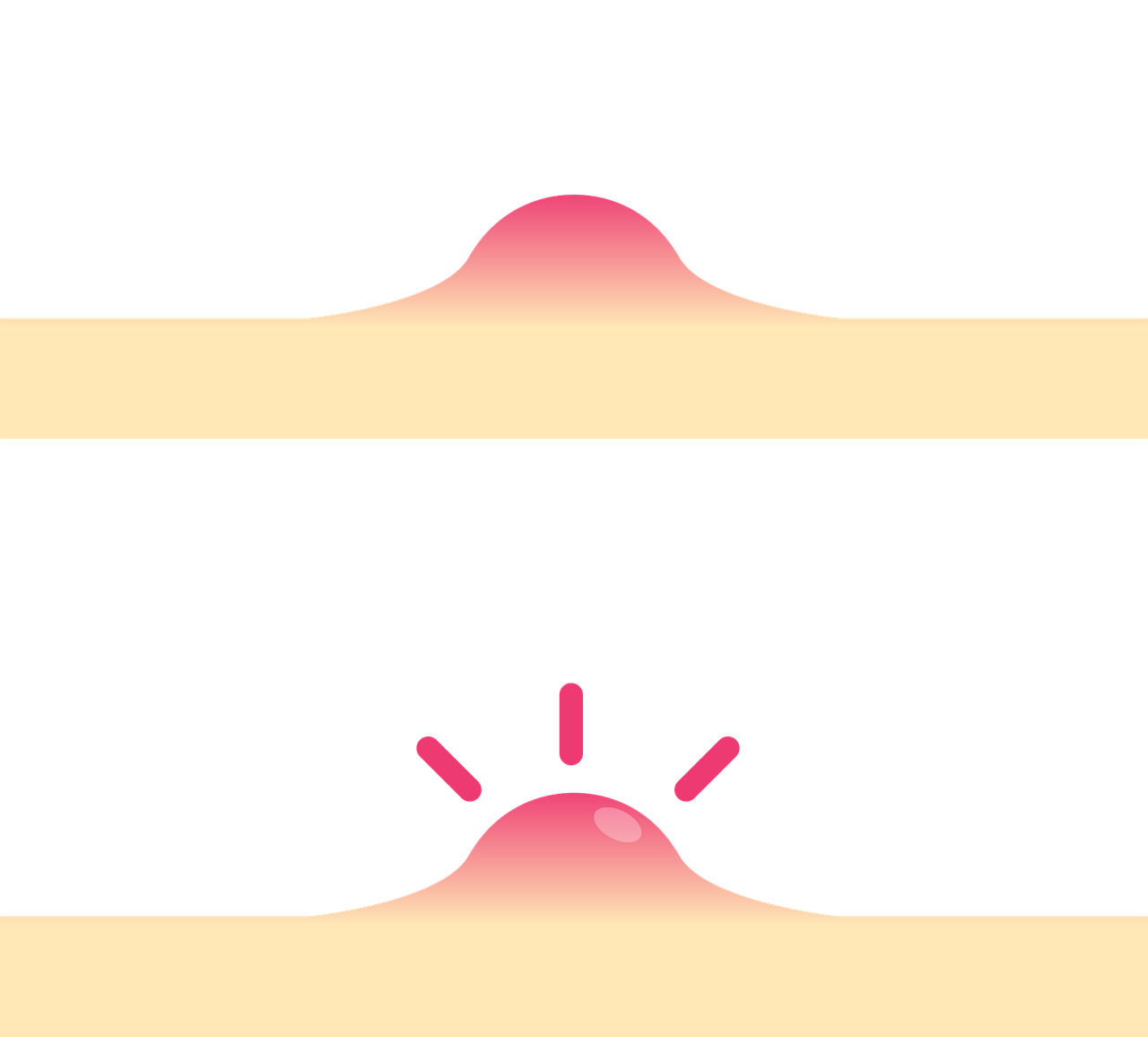 사춘기 여드름