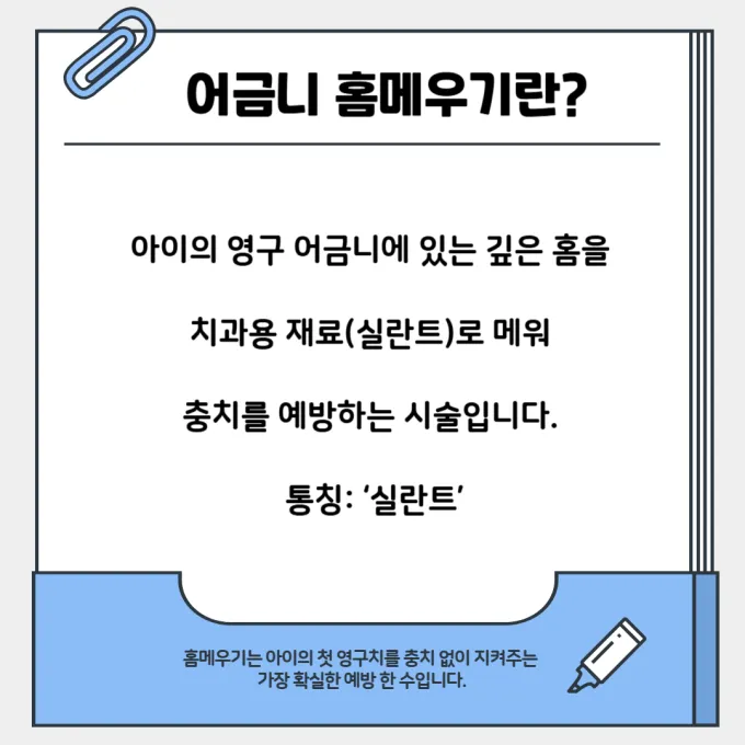 어금니 홈메우기