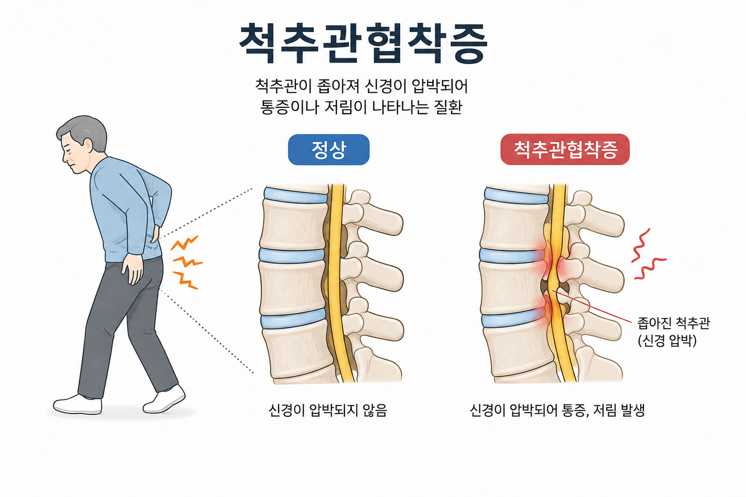 척추관협착증