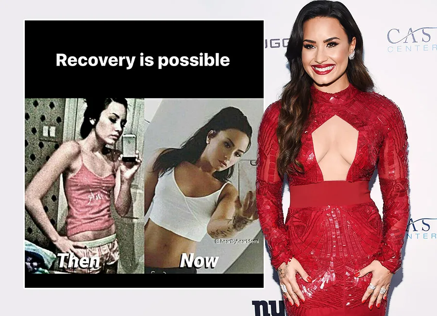 섭식장애 데미 로바토