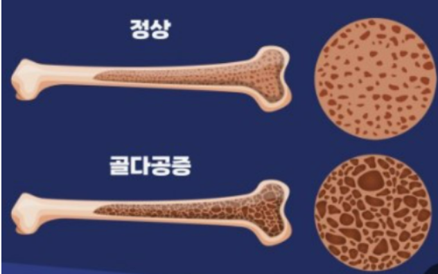 정상뼈와 골다공증 뼈