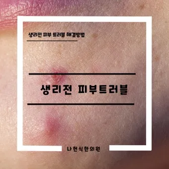 생리 전 뾰루지 폭발 원인과 해결법 7가지 생리 전후 뾰루지 발생 이유 완벽 분석_7