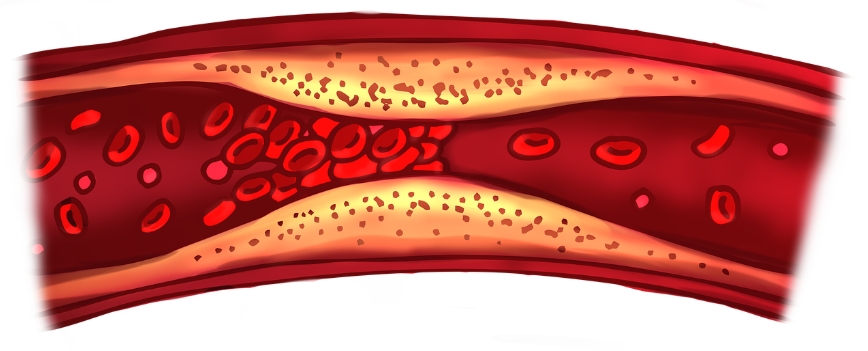 콜레스테롤에 혈관이 막혀가는 그림