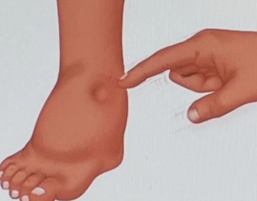 혈액순환이 안된 발