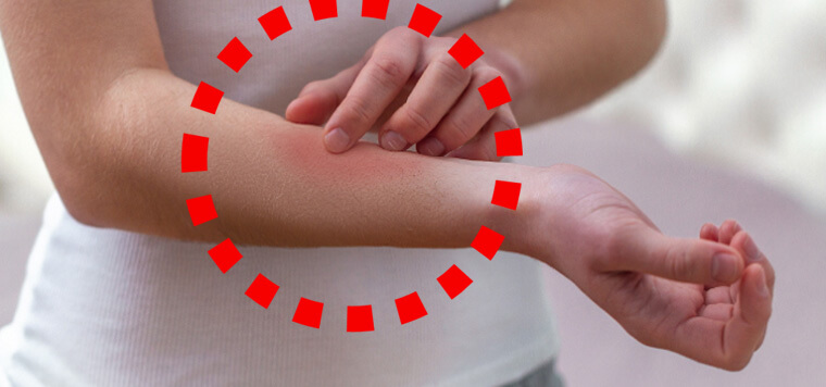 팔에-두드러기가-난-여성-사진