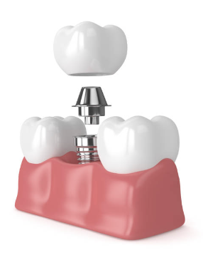 어금니 임플란트 가격