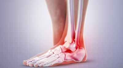 족저근막염 이미지