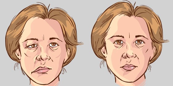 안면마비 자주 묻는 질문 FAQ