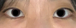 여자 무쌍 눈매 교정