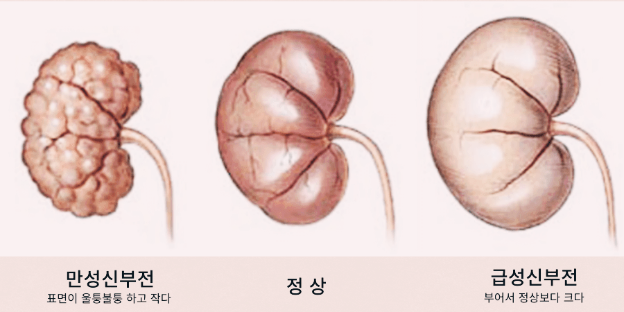 만성 신부전, 콩팥